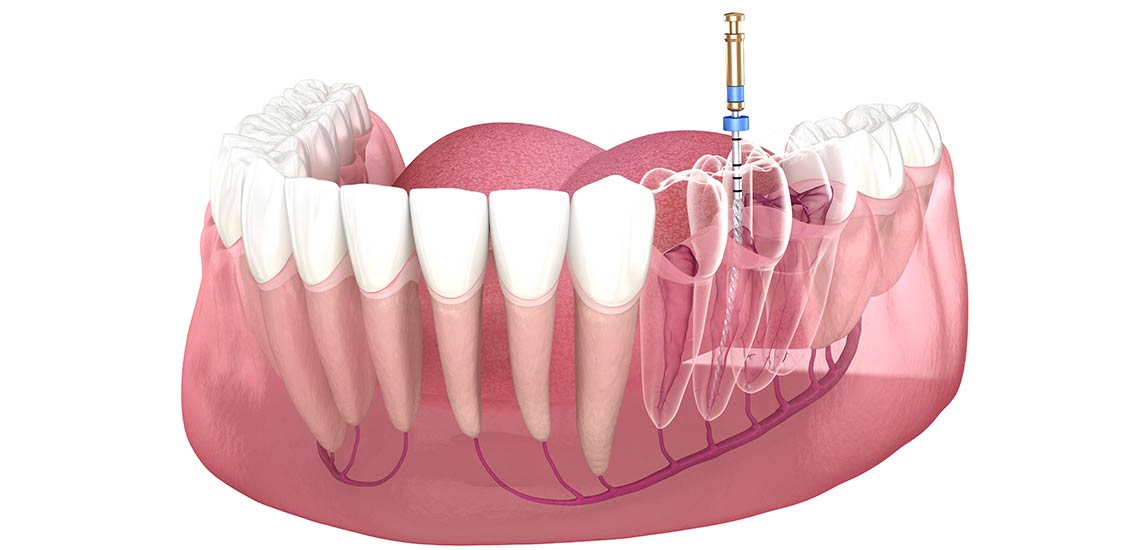Dental RCT treatement